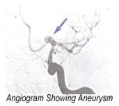 angiogram